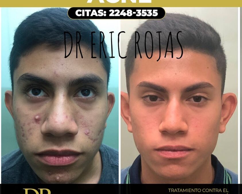 Tratamiento para el acné.