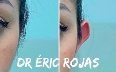 Corrección de Orejas, Dr. Eric Rojas Blanco.
