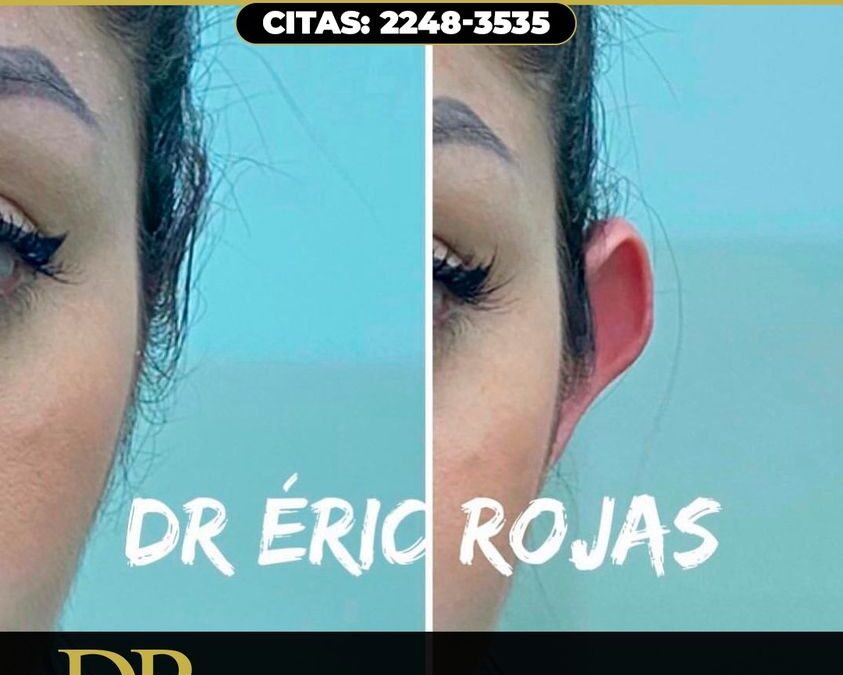Corrección de Orejas, Dr. Eric Rojas Blanco.