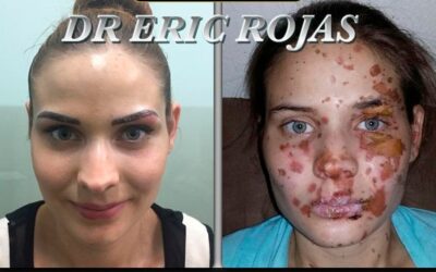Tratamos todo tipo de quemaduras, Dr.Eric Rojas Blanco.