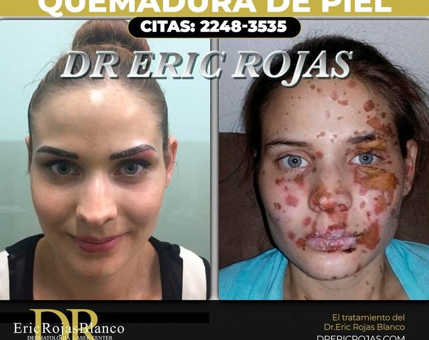 Tratamos todo tipo de quemaduras, Dr.Eric Rojas Blanco.