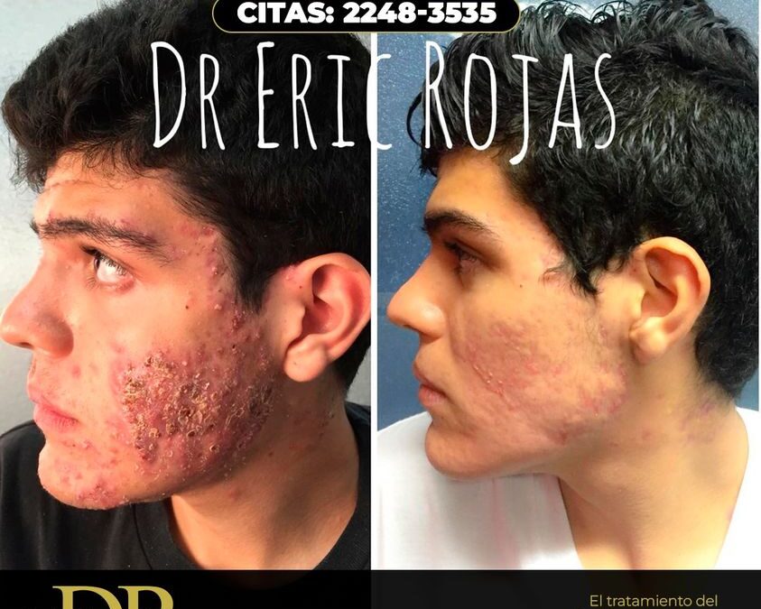 Sin acné todo es mejor.