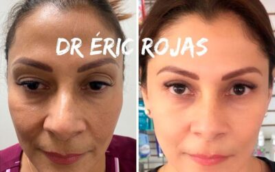 REJUVENECIMIENTO FACIAL.