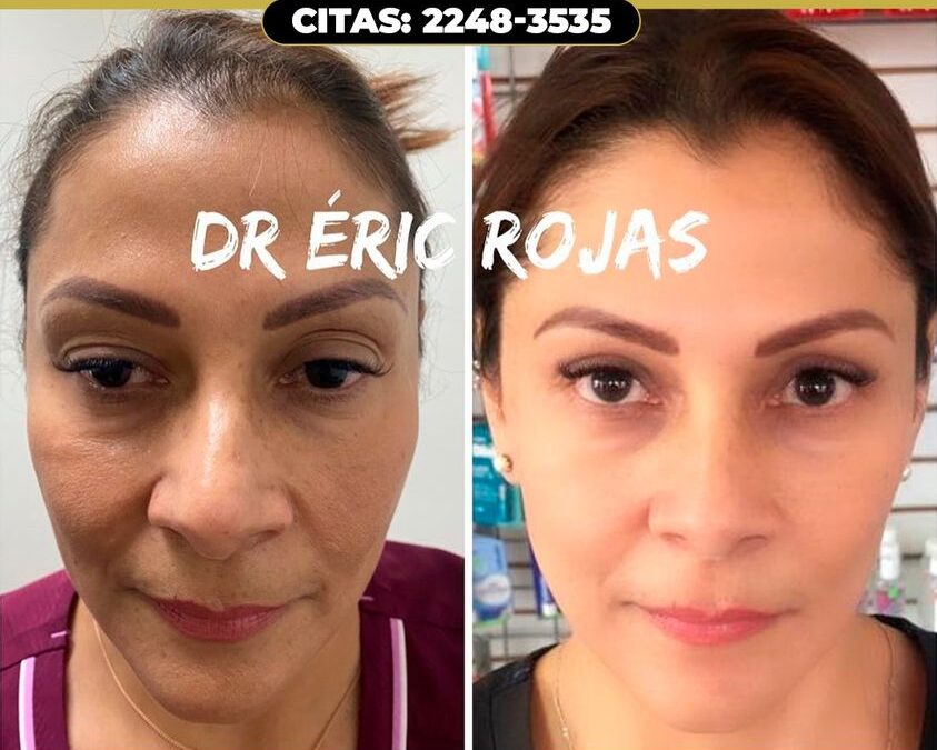 REJUVENECIMIENTO FACIAL.