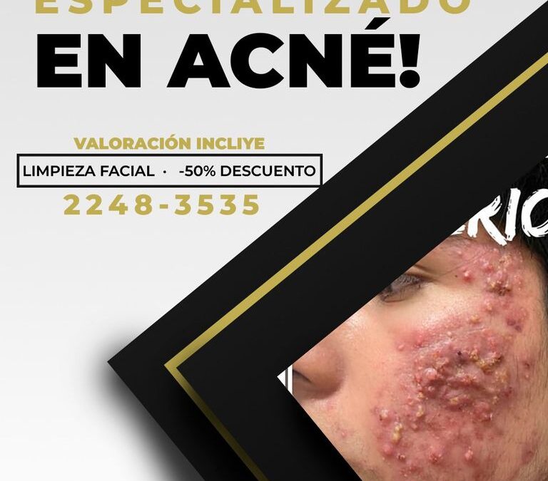 Es momento de decirle adiós al acné con nuestro tratamiento.