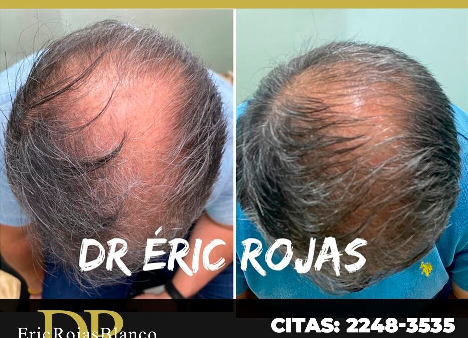 Crecimiento del cabello con el Dr. Eric Rojas Blanco