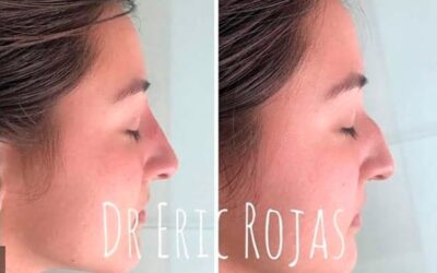 Perfilado con excelentes resultados.
