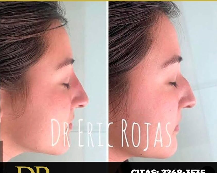 Perfilado con excelentes resultados.