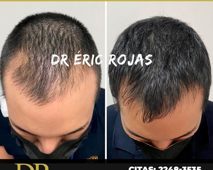 No perdás tu cabello.