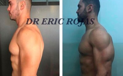 Resultados de Rinolift, Dr. Eric Rojas Blanco.