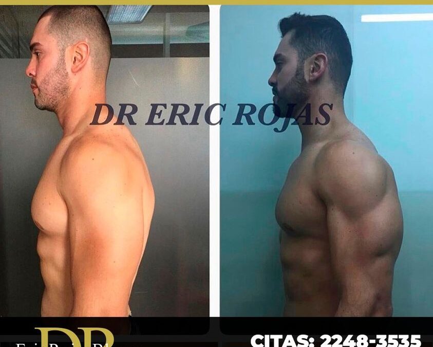 Resultados de Rinolift, Dr. Eric Rojas Blanco.