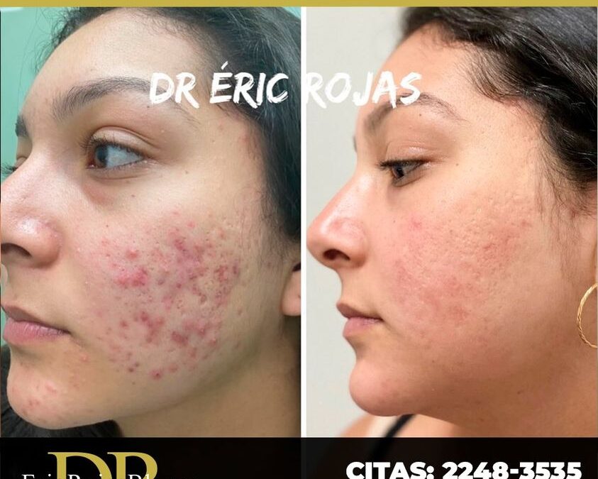 Con nuestro tratamiento no hay acné.