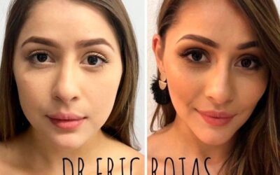 Perfilado facial, Dr. Eric Rojas Blanco.