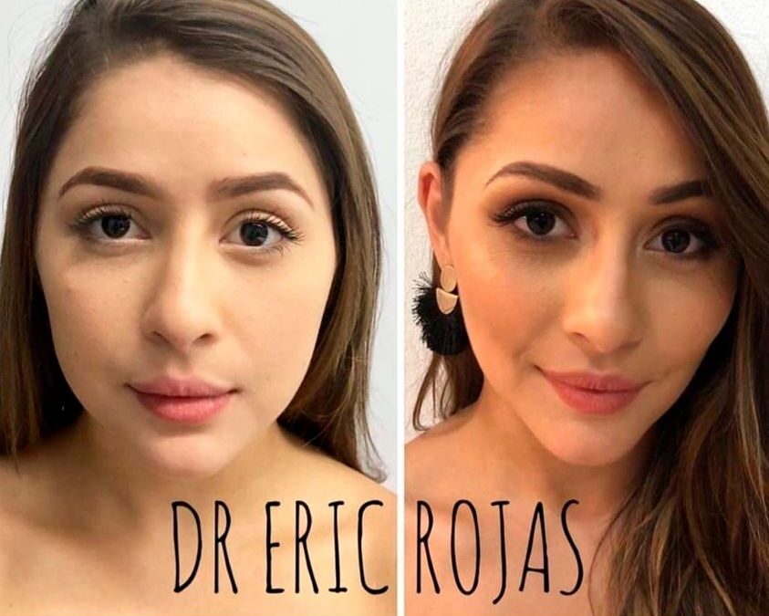 Perfilado facial, Dr. Eric Rojas Blanco.
