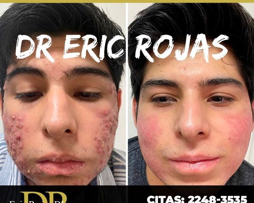 Nosotros tenemos la solución contra el acné.