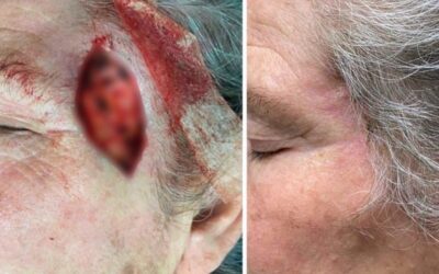 Paciente con cancer de piel, el cual fue removido con éxito.
