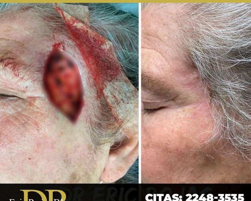 Paciente con cancer de piel, el cual fue removido con éxito.