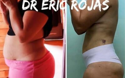Resultados de Slim Láser. Dr. Eric Rojas Blanco.