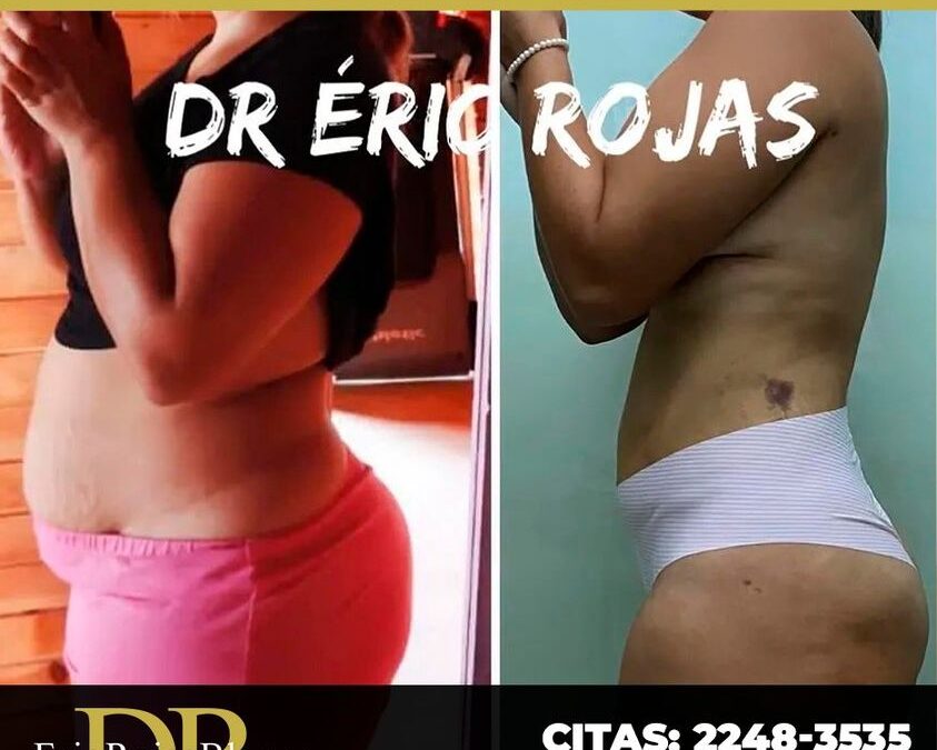 Resultados de Slim Láser. Dr. Eric Rojas Blanco.