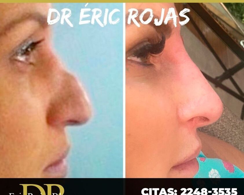 Resultados de Rinolift, Dr. Eric Rojas Blanco.