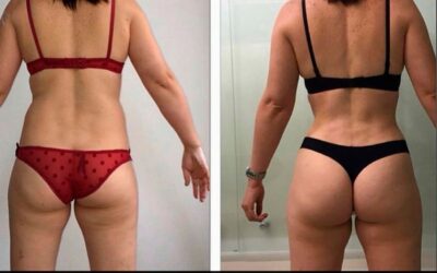 Slim Láser, contamos con el mejor equpo.