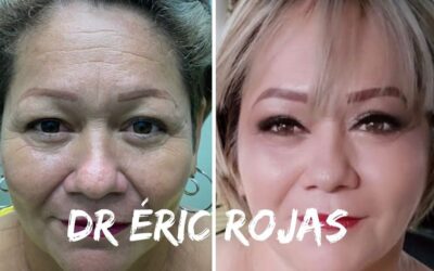 REFRESCAMIENTO FACIAL DR ÉRIC ROJAS
