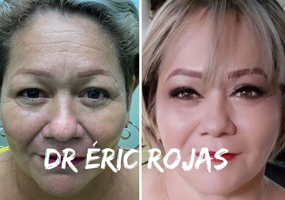 REFRESCAMIENTO FACIAL DR ÉRIC ROJAS