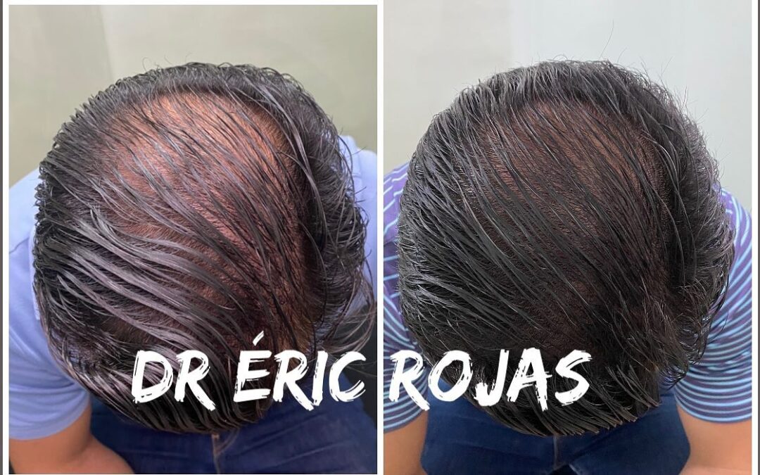 YA NO MÁS CAÍDA DE CABELLO