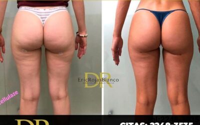 ¿Quieres eliminar tu celulitis?