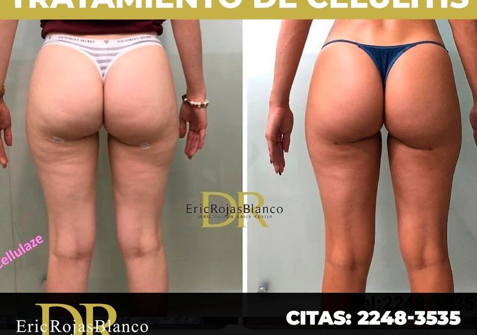 ¿Quieres eliminar tu celulitis?