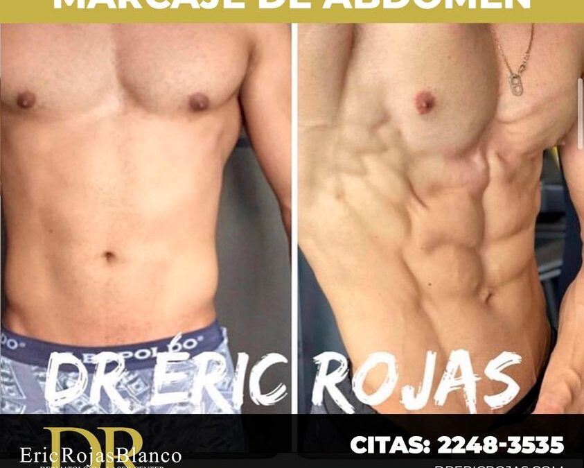Marcaje de abdomen con el Dr. Eric Rojas.