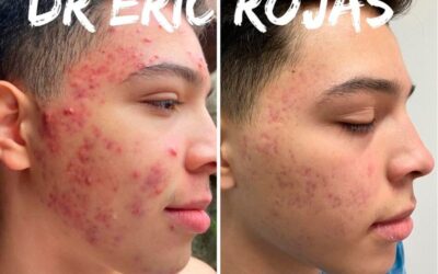 Simplemente no más acné con el Dr. Eric Rojas Blanco.