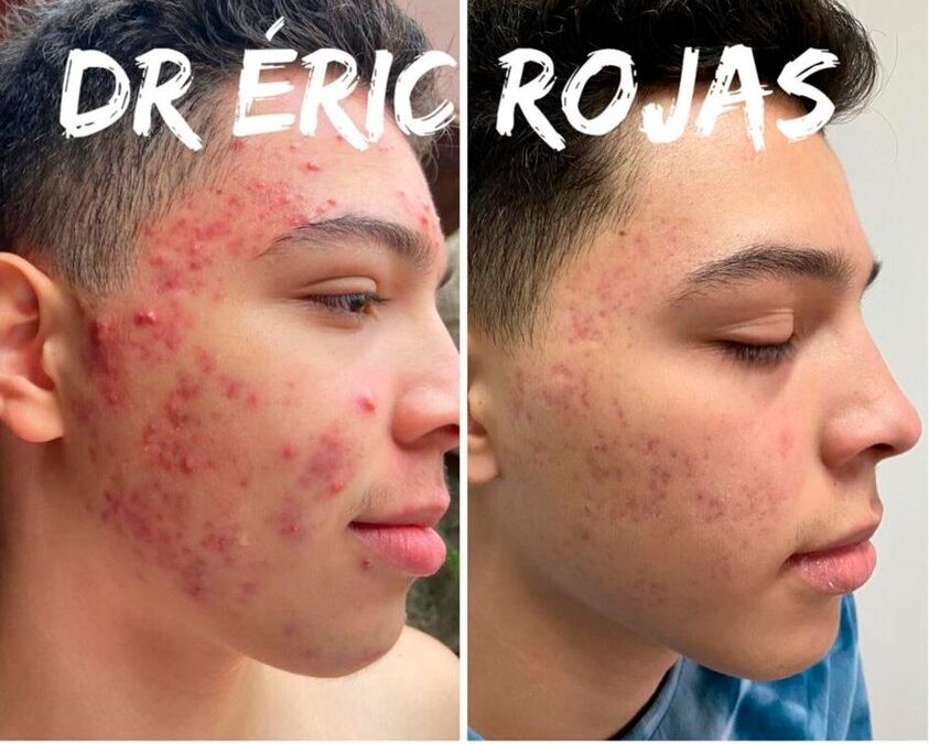 Simplemente no más acné con el Dr. Eric Rojas Blanco.