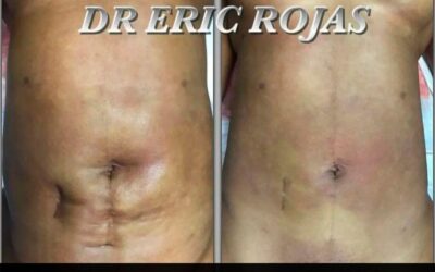 Cesárea, cicatriz de apendicectomía, además de una liposucción anterior.