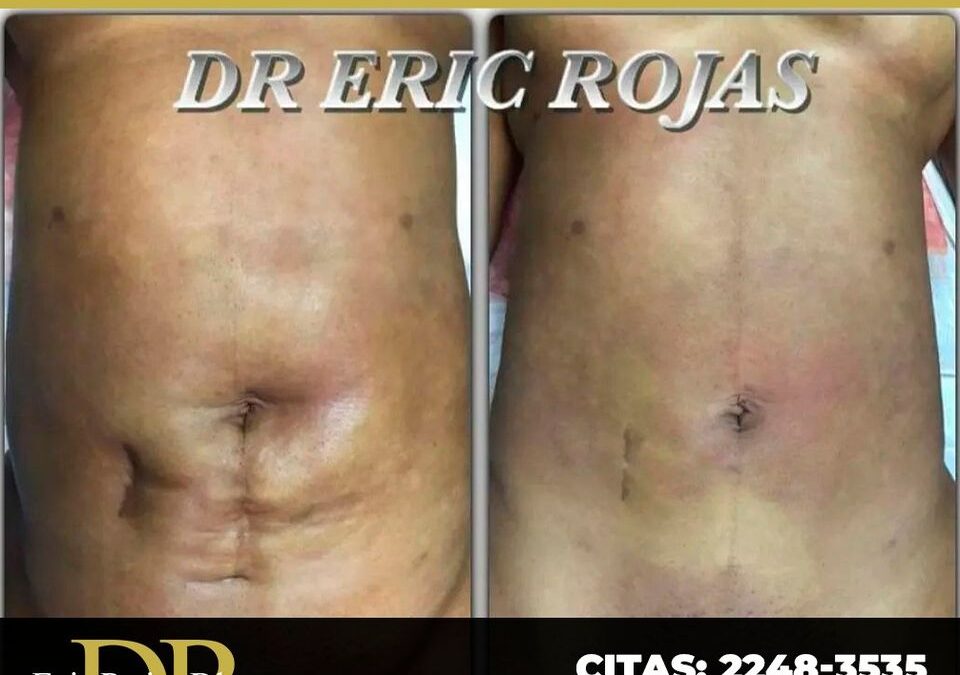 Cesárea, cicatriz de apendicectomía, además de una liposucción anterior.