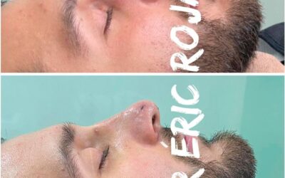 Corrección de nariz, Rinolift con el Dr. Eric Rojas Blanco.