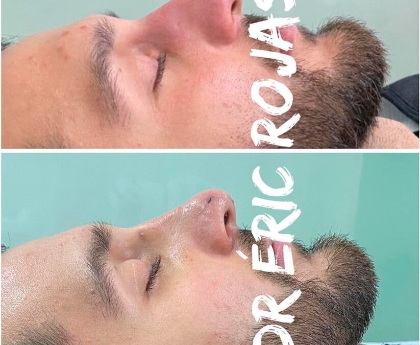 Corrección de nariz, Rinolift con el Dr. Eric Rojas Blanco.