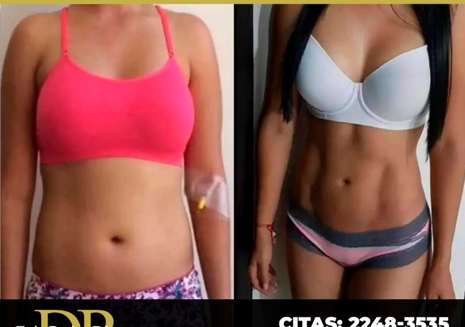 Slim Láser con el Dr. Eric Rojas Blanco.