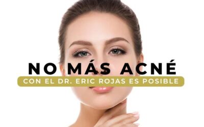 ¡ES MOMENTO DE DECIR «NO MÁS ACNÉ»!
