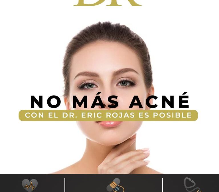 ¡ES MOMENTO DE DECIR «NO MÁS ACNÉ»!