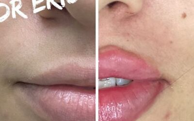 Aumento de labios con el Dr. Eric Rojas Blanco.