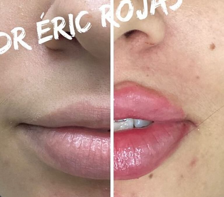 Aumento de labios con el Dr. Eric Rojas Blanco.
