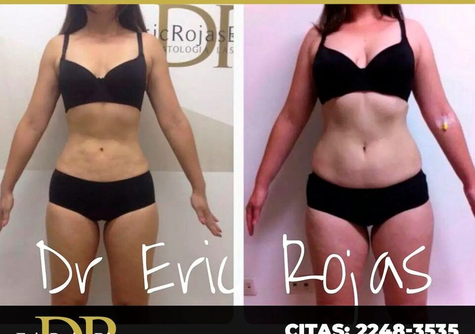 Slim Láser con excelentes resultados.