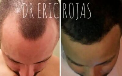 Luego de 5 meses con tratamiento para el crecimiento del cabello con el Dr. Eric Rojas.