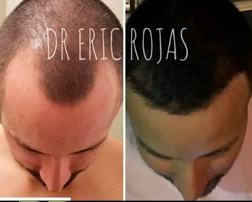 Luego de 5 meses con tratamiento para el crecimiento del cabello con el Dr. Eric Rojas.