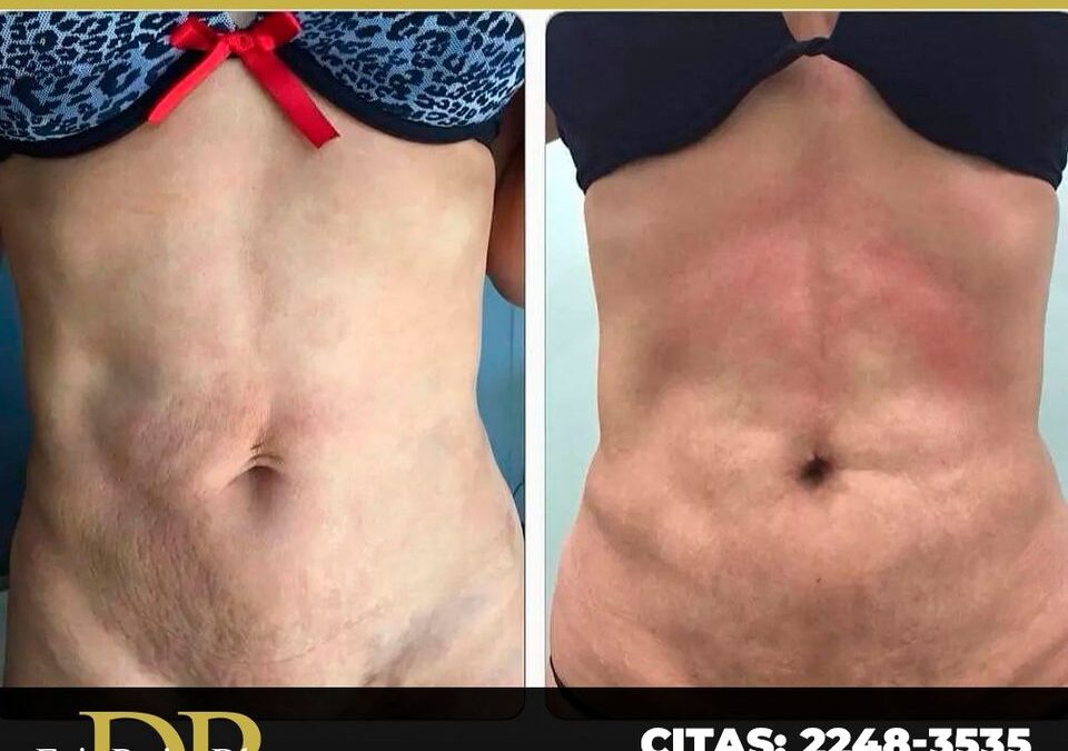 Mejoría de ombligo caido.