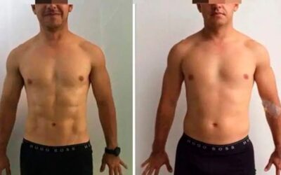 Marcaje de abdomen con el Dr. Eric Rojas Blanco.