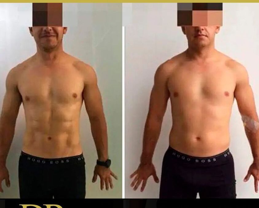 Marcaje de abdomen con el Dr. Eric Rojas Blanco.