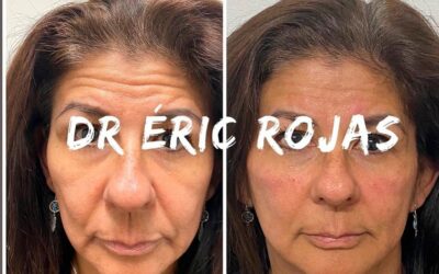 Rejuvenecimiento con el Dr.Eric Rojas.