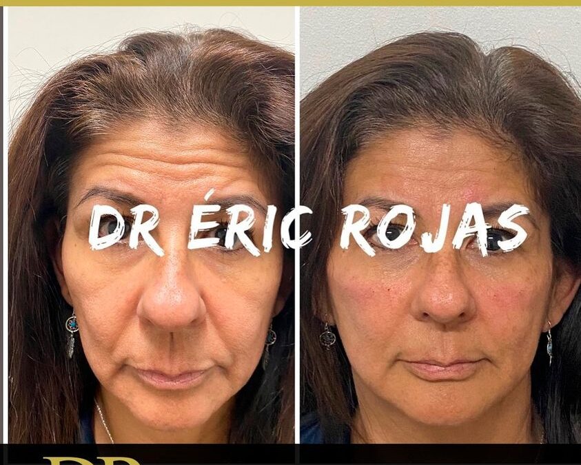 Rejuvenecimiento con el Dr.Eric Rojas.